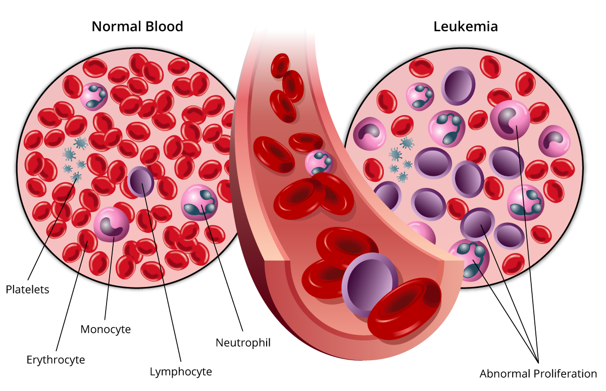 leukemia blood cells
